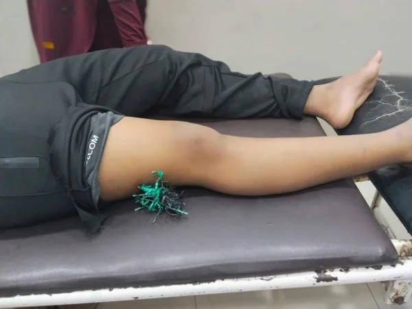 Anak Panah Tertancap di Paha Korban. (Dok: Ist)