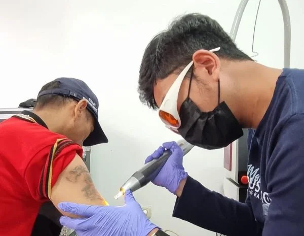 Penghapusan tato gratis (Dok: Ist)