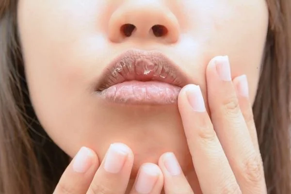 Cegah bibir kering saat berpuasa (Dok: Alodokter).