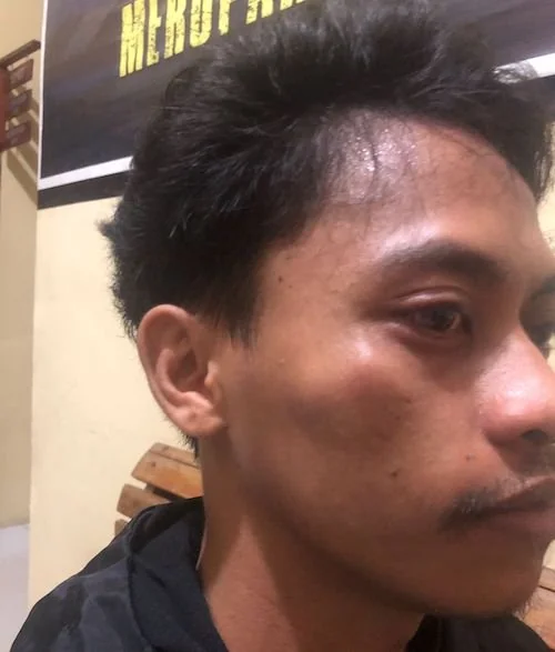 Korban Penganiayaan Diduga oleh Oknum Satnarkoba Polres Luwu Timur