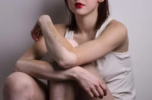 Penderita penyakit vitiligo (Dok: Int)